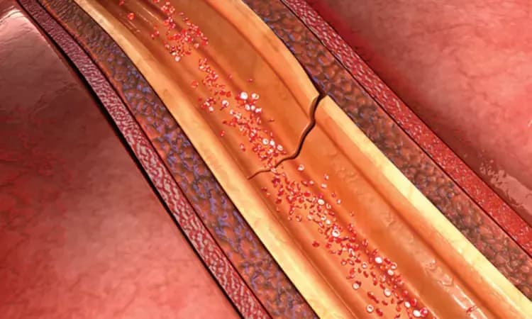 Pregnancy-Associated Spontaneous Coronary Artery Dissection: A Report of the iSCAD Registry
